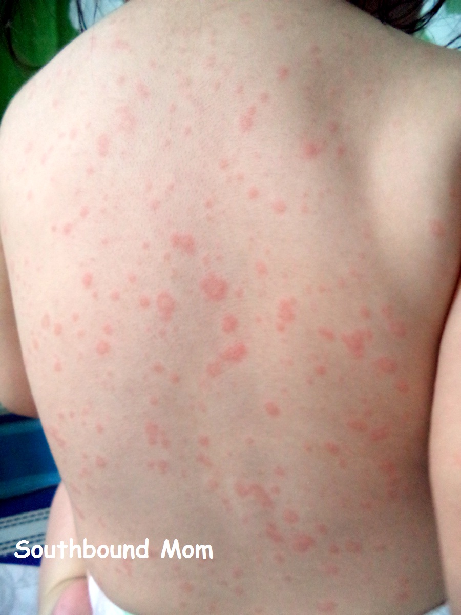 measle rash picture
