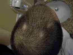 Is It Possible To Regrow Hair On Bald Spot