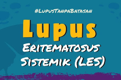 Apa Itu Penyakit Lupus Eritematosus Sistemik (LES) ?