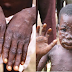 BREAKING: Monkeypox spreads to Rivers and Akwa Ibom
