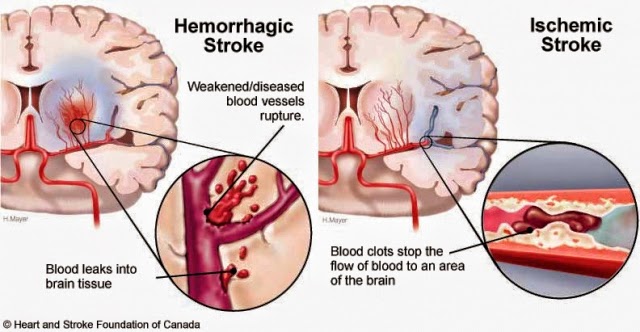 ischemic and hemorrhagic stroke
