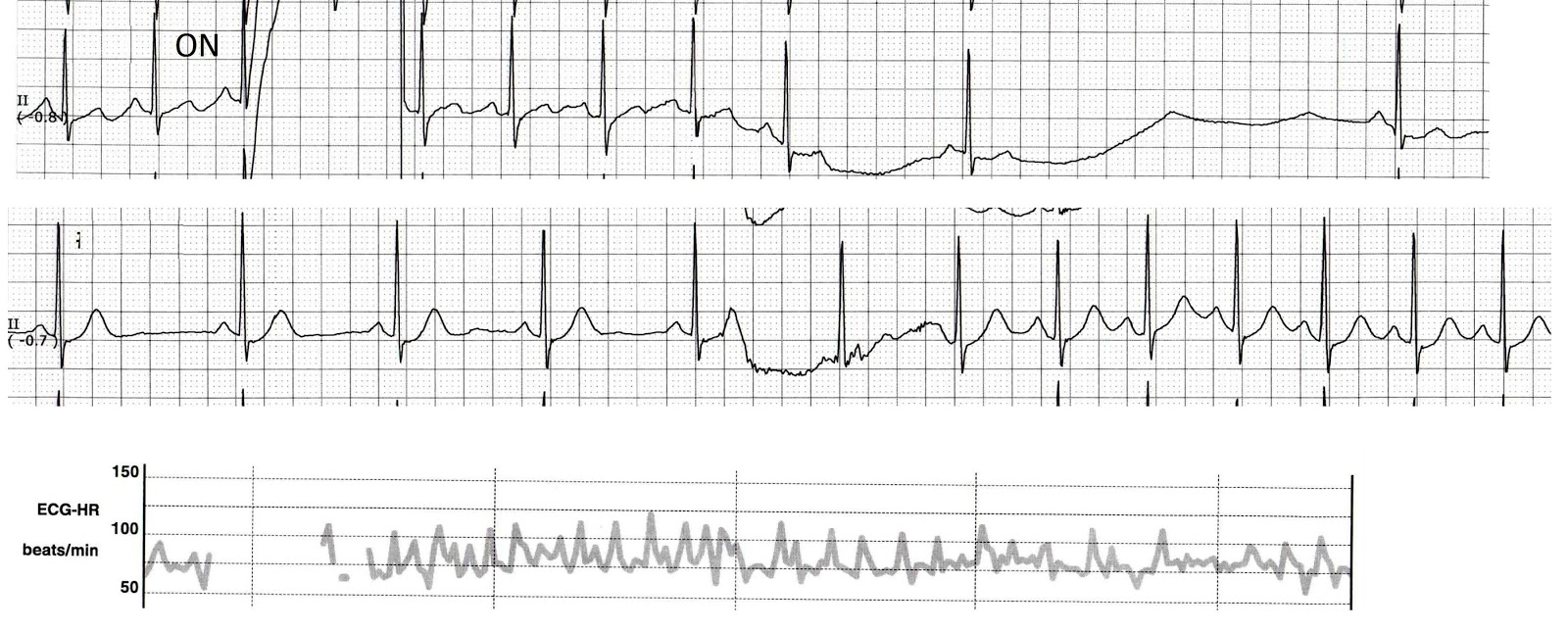 ECG Rhythms Bradycardia due to a neuro device