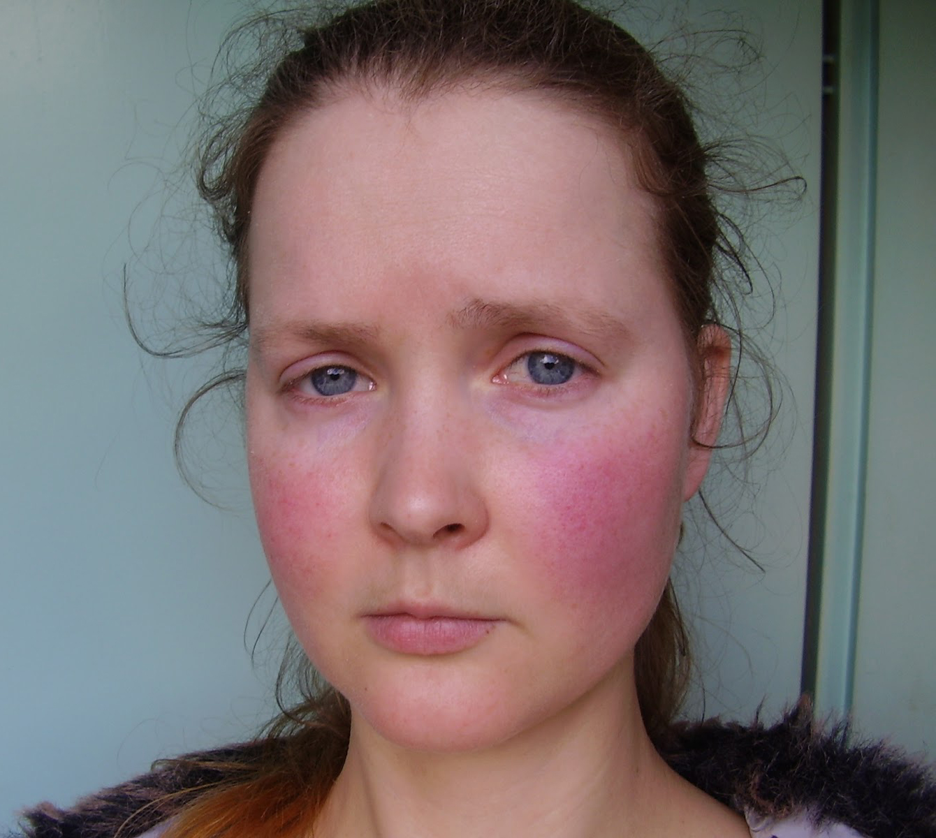 Midget stripper movie Causes of facial flushing and lidocaine