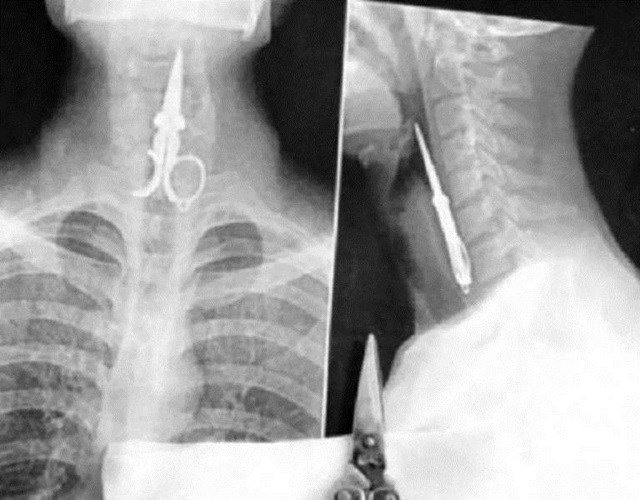De anel a vibrador: veja os 6 objetos mais estranhos já encontrados em raios X De anel a vibrador: veja os 6 objetos mais estranhos já encontrados em raios X