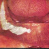 Λευκοπλακία, μια προκαρκινική βλάβη στο στόμα που πρέπει να αφαιρείται 