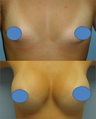 silicone nos seios antes e depois silicone nos seios antes e depois