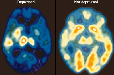 genes causing depression in humans