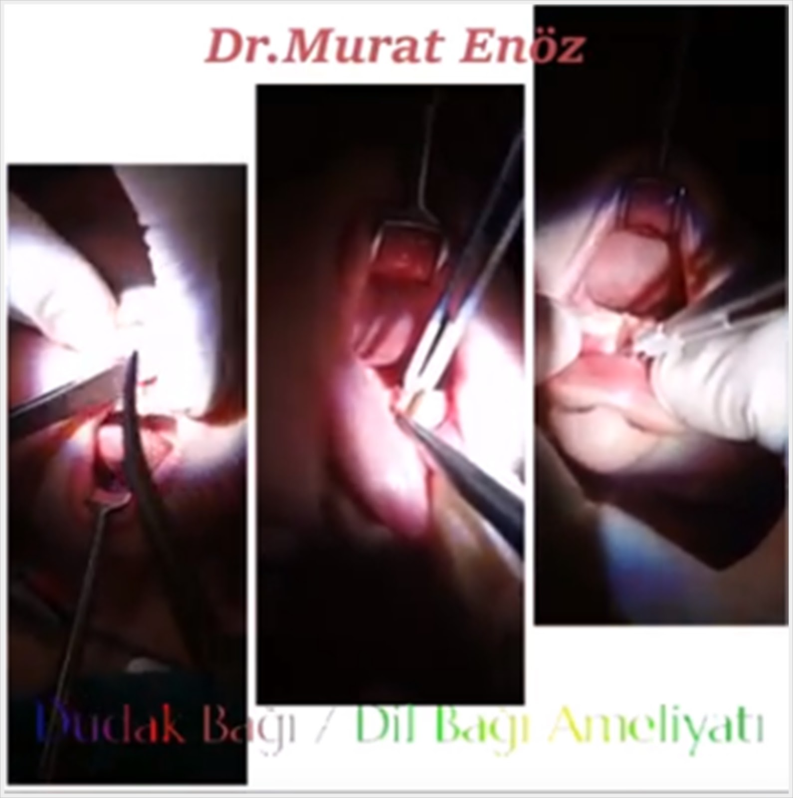 Thermal Welding Cihazı İle Dudak Bağı Ameliyatı ve Dil Thermal Welding Cihazı İle Dudak Bağı Ameliyatı ve Dil