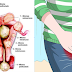 Alternative Home Treatment For Myomas And How To Prevent It Naturally