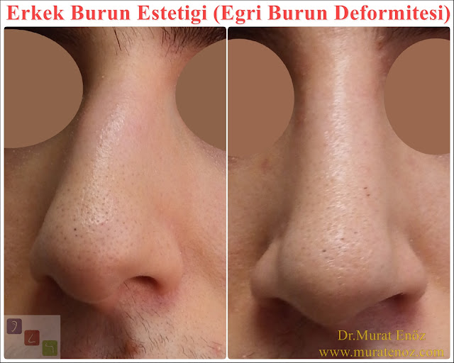 Crooked nose - Deviated nose - Twisted nose - Deflected nose - Asymmetric nose - Scoliotic nose - Eğri burun - C burun - S-shaped crooked nose deformity -  Rhinoplasty Istanbul - Rhinoplasty in Istanbul - Rhinoplasty Turkey - Rhinoplasty in Turkey – Rhinoplasty doctor in Istanbul – ENT doctor in Istanbul - Nose Job in Istanbul - Before and after rhinoplasty photos