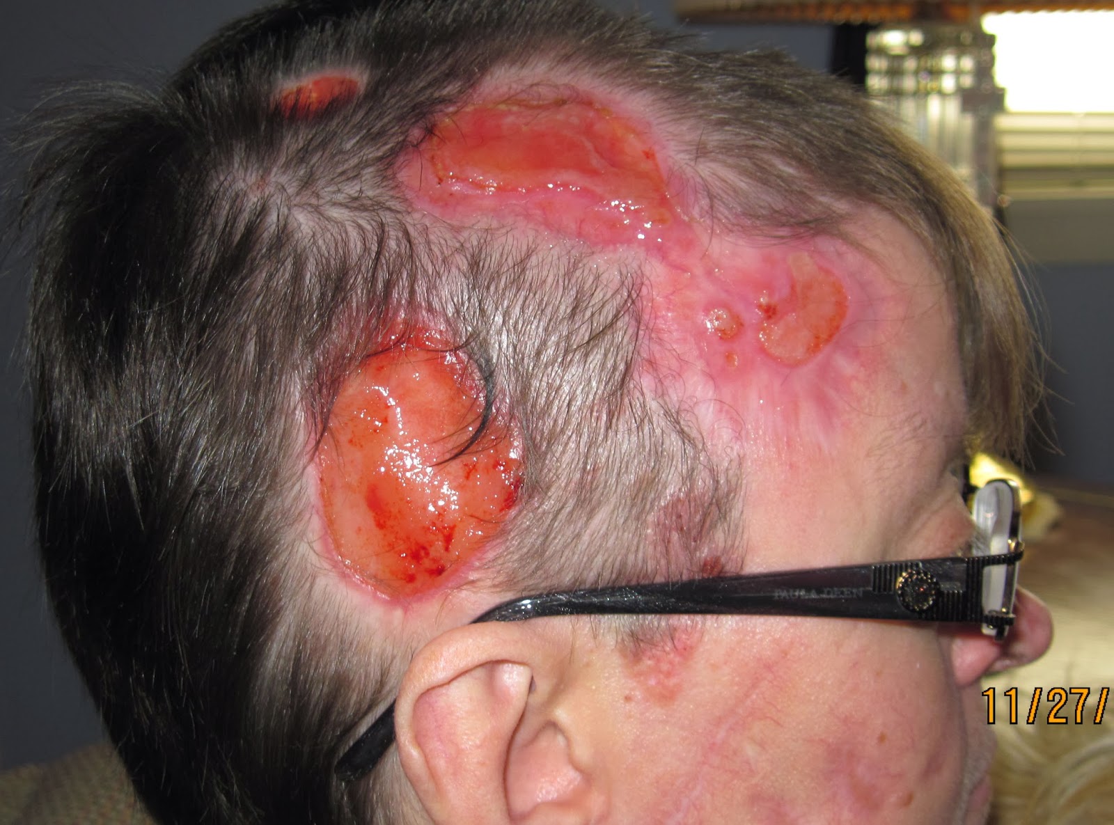 Nevoid basal-cell carcinoma syndrome - Wikipedia