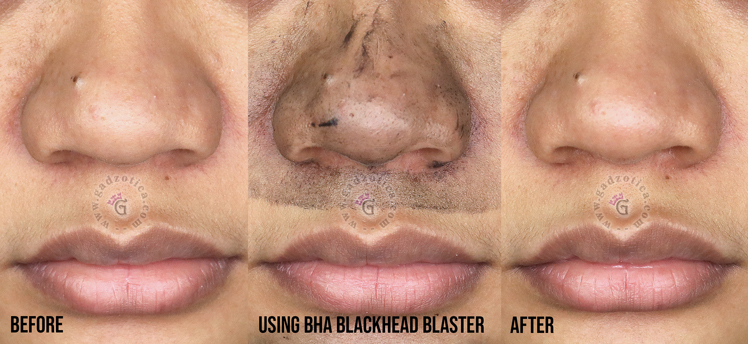 A'bloom BHA Blackhead Blaster Review