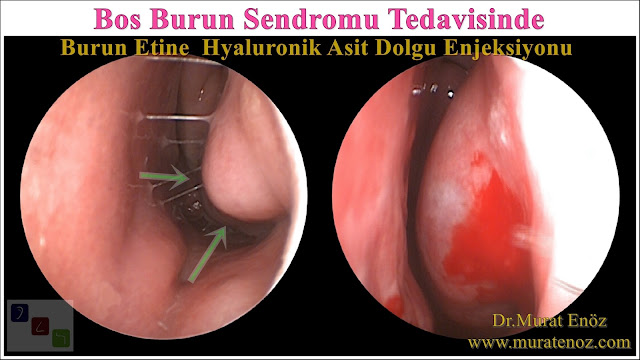 Boş burun sendromu tanımı - Boş burun sendromu belirtileri - Boş burun sendromu tedavisi - Boş burun sendromu tedavisinde Hyaluronik Asit dolgusu - Burun eti dolgusu - Treatment of Empty nose syndrome with hyaluronic acid filler - Boş burun - Geniş burun boşluğu sendromu - Burun eti büyütülmesi - Empty Nose Syndrome (ENS)