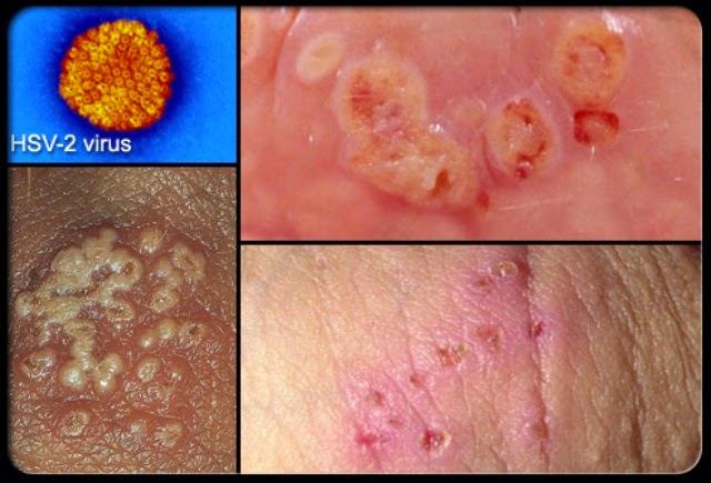 Stages of Herpes - Three Steps