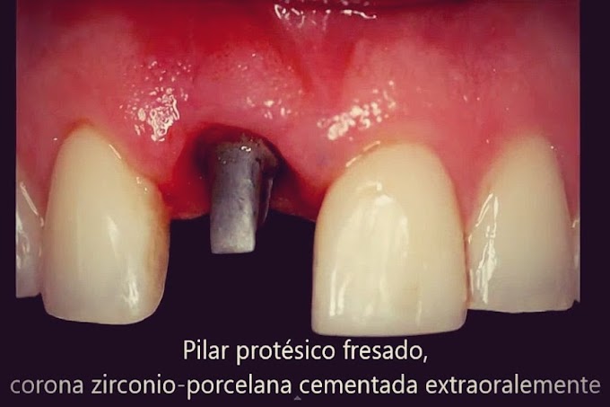IMPLANTOLOGÍA: Fracaso de incisivo superior y colocación de implante dental