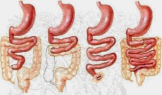 Síndrome de intestino corto (SIC) y como tratarlo con la comida