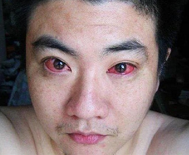 This man was diagnosed with eye cancer after using his mobile phone every night! This man was diagnosed with eye cancer after using his mobile phone every night!