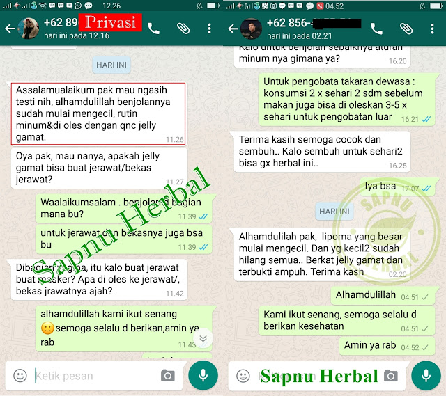 Cara Menghilangkan Lipoma Tanpa Operasi Terbukti Manjur Cara Menghilangkan Lipoma Tanpa Operasi Terbukti Manjur