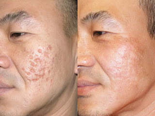 What Removes Acne Scars Effectively with Less of Risk