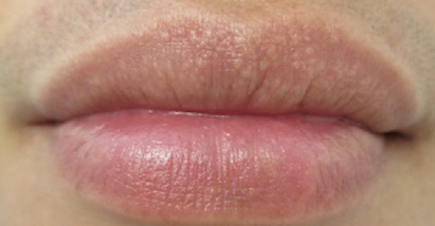 Cara Menghilangkan Fordyce Spot Di Bibir Secara Alami  Menghilangkan 