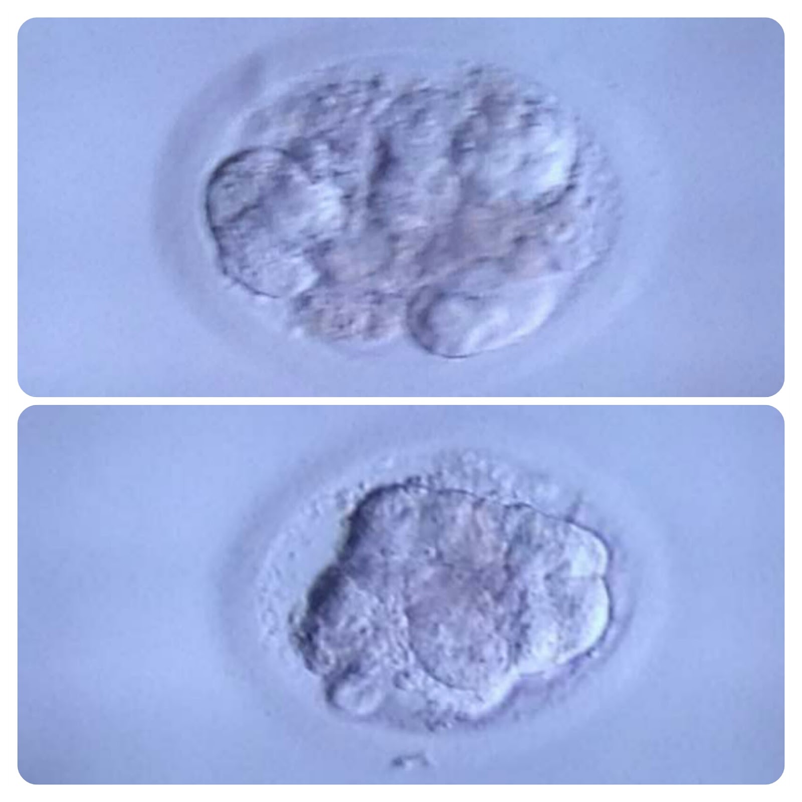 Babyinthemaking Ivf 2 FET 1 Frozen Embryo Transfer day