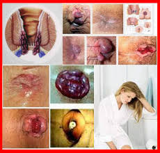 Foto Jual Obat Wasir Ambeven Manjur di Apotik Herbal