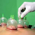 8 Benefits of Cupping For Cancer Required to Know 