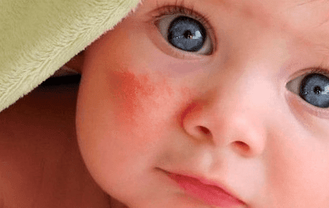 alergi susu formula pada bayi baru lahir