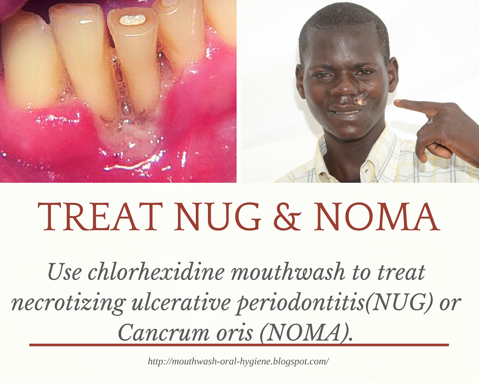 Use Chlorhexidine Mouthwash To Treat NUG And NOMA Mouthwash Guide For