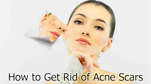 How to Get Rid of Acne Scars How to Get Rid of Acne Scars