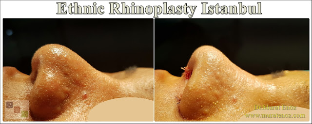 Ethnic Rhinoplasty Istanbul – Nose job in Istanbul – Nose surgery in Istanbul – Nose job in Turkey - Ethnic rhinoplasty Turkey - Ethnic rhinoplasty in Turkey - African American rhinoplasty - Ethnic expert nose job surgeon - Rhinoplasty surgeon in Istanbul - Black nose job - Rhinoplasty for ethnic nose - Rhinoplasty for African people - African American nose surgery – Rhinoplasty for African American Nose - Thick skin rhinoplasty - Rhinoplasty in istanbul Ethnic Rhinoplasty Istanbul – Nose job in Istanbul – Nose surgery in Istanbul – Nose job in Turkey - Ethnic rhinoplasty Turkey - Ethnic rhinoplasty in Turkey - African American rhinoplasty - Ethnic expert nose job surgeon - Rhinoplasty surgeon in Istanbul - Black nose job - Rhinoplasty for ethnic nose - Rhinoplasty for African people - African American nose surgery – Rhinoplasty for African American Nose - Thick skin rhinoplasty - Rhinoplasty in istanbul