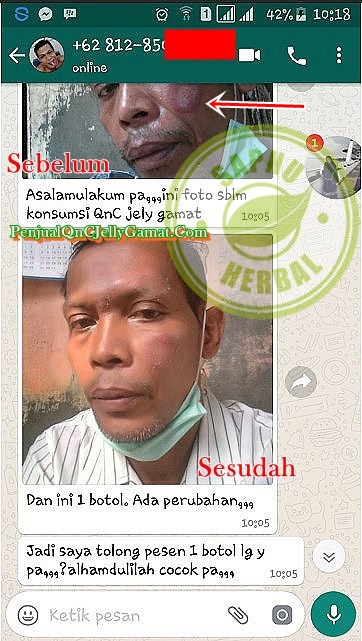 Cara Mengobati Infeksi Kulit Selulitis Secara Alami Sampai Tuntas Cara Mengobati Infeksi Kulit Selulitis Secara Alami Sampai Tuntas