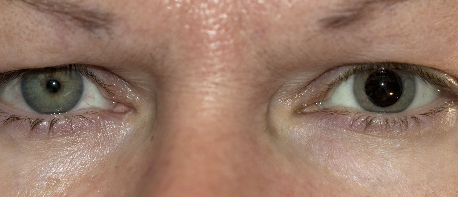 Ирифрин глазные зрачки. Расширенные зрачки после закапывания. Ирифрин глазные капли зрачки. Мидриаз после ирифрина. Расширение зрачка от капель.