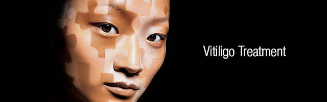 http://drrsroy.com/vitiligo.html