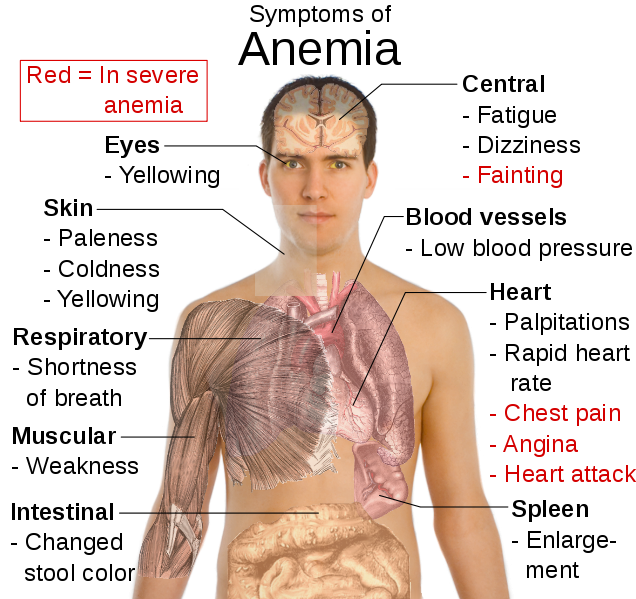 Dental Mnemonics Clinical Manifestation of Anemia