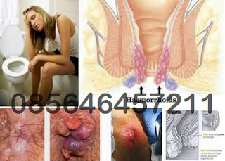 Nama Obat Wasir (Ambeien) di Apotik Online Nama Obat Wasir (Ambeien) di Apotik Online