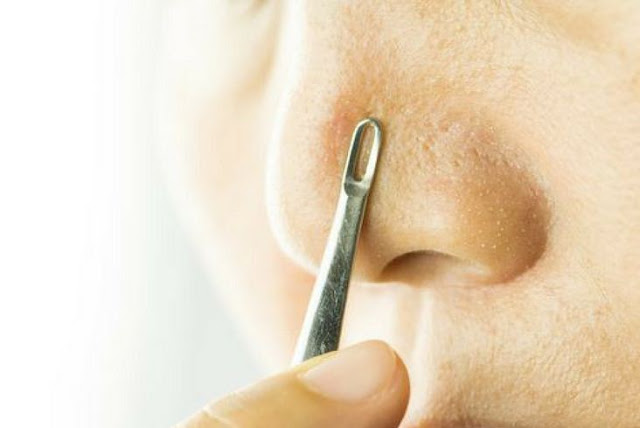 How to Get Rid of Whiteheads Naturally at Home?