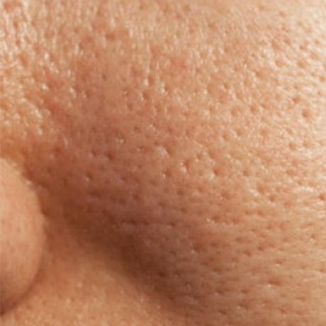 Comme nettoyer la peau huileuse de la personne des points noirs