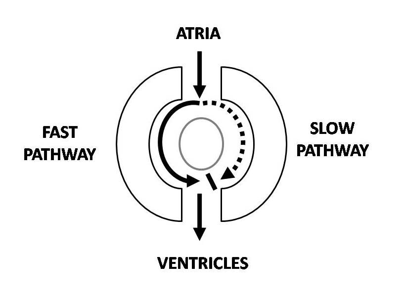 ECG Rhythms Atrial Arrhythmia Triggering AVNRT