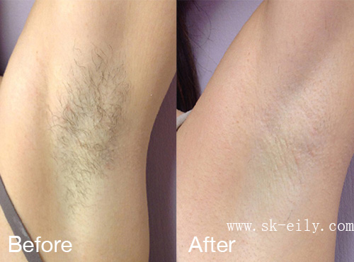 laser-hair-removal-0521-7.jpg