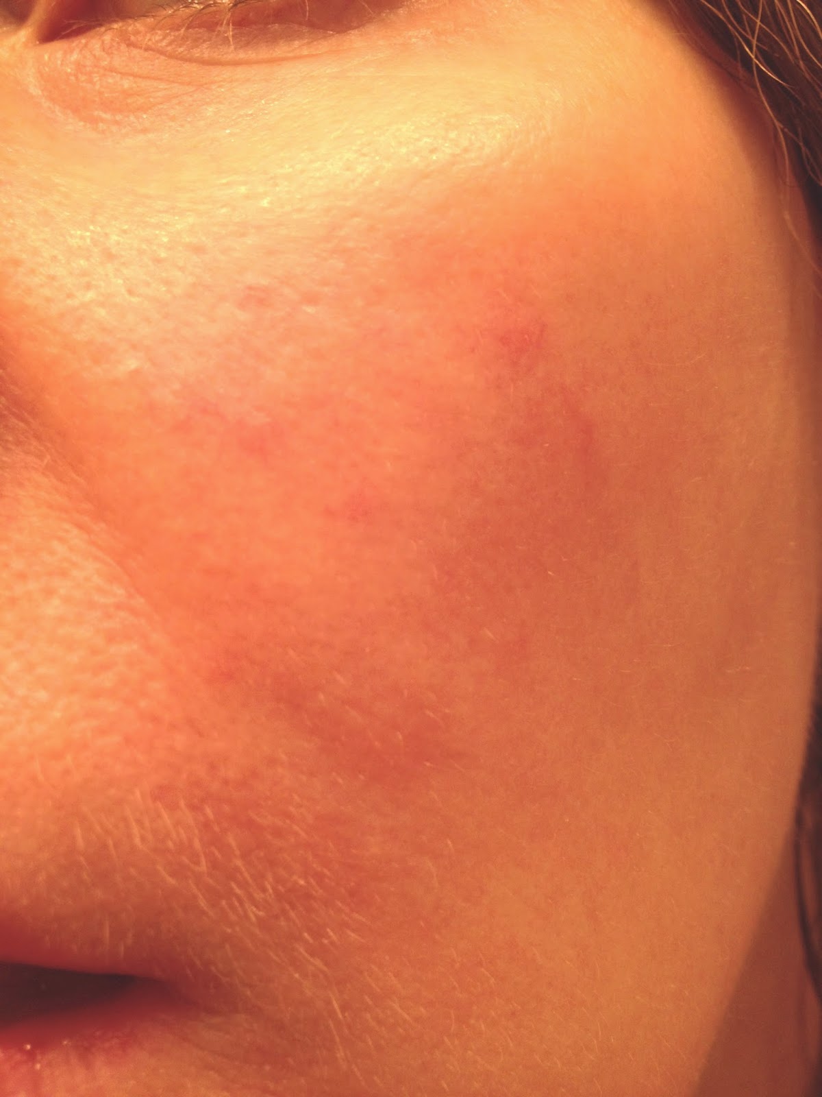 Chemical Peels for Acne and Anti Aging Glycolic Acid a Miracle for Acneprone Skin