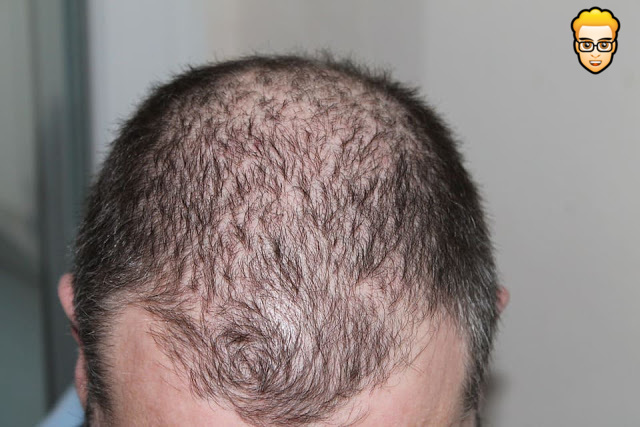 اسباب تساقط الشعر عند الرجال في سن مبكر وطرق علاجها