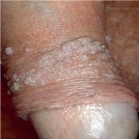 Foto Salep Jamur Kutil Kelamin Herbal