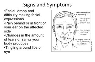 signs and symptoms of bell's palsy