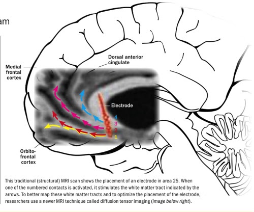 Advancements in Meta Psychology: A Wiring Diagram in the Brain for