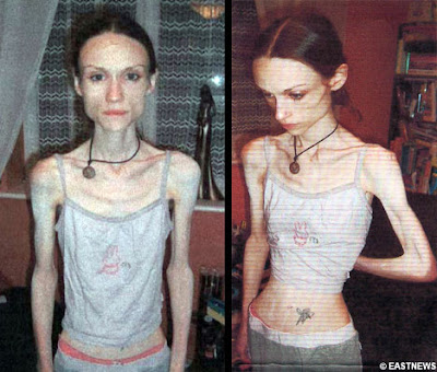 http://4.bp.blogspot.com/_10yYjoTIYE0/SOITcCHH3kI/AAAAAAAACIE/Lwqx_TU3NUE/s400/Lauren+Bailey+-+recovered+anorexic.jpg