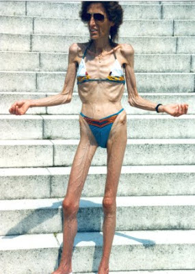 Anorexic+woman.jpg