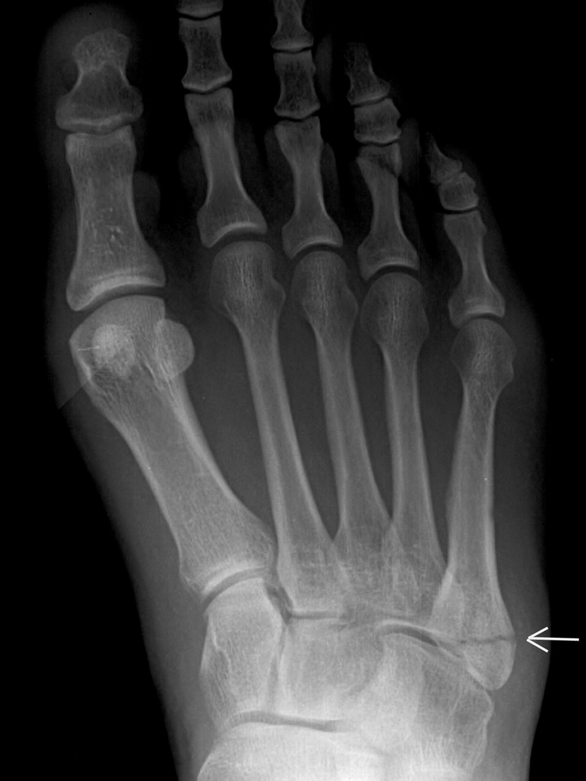 [Jones+Fracture]