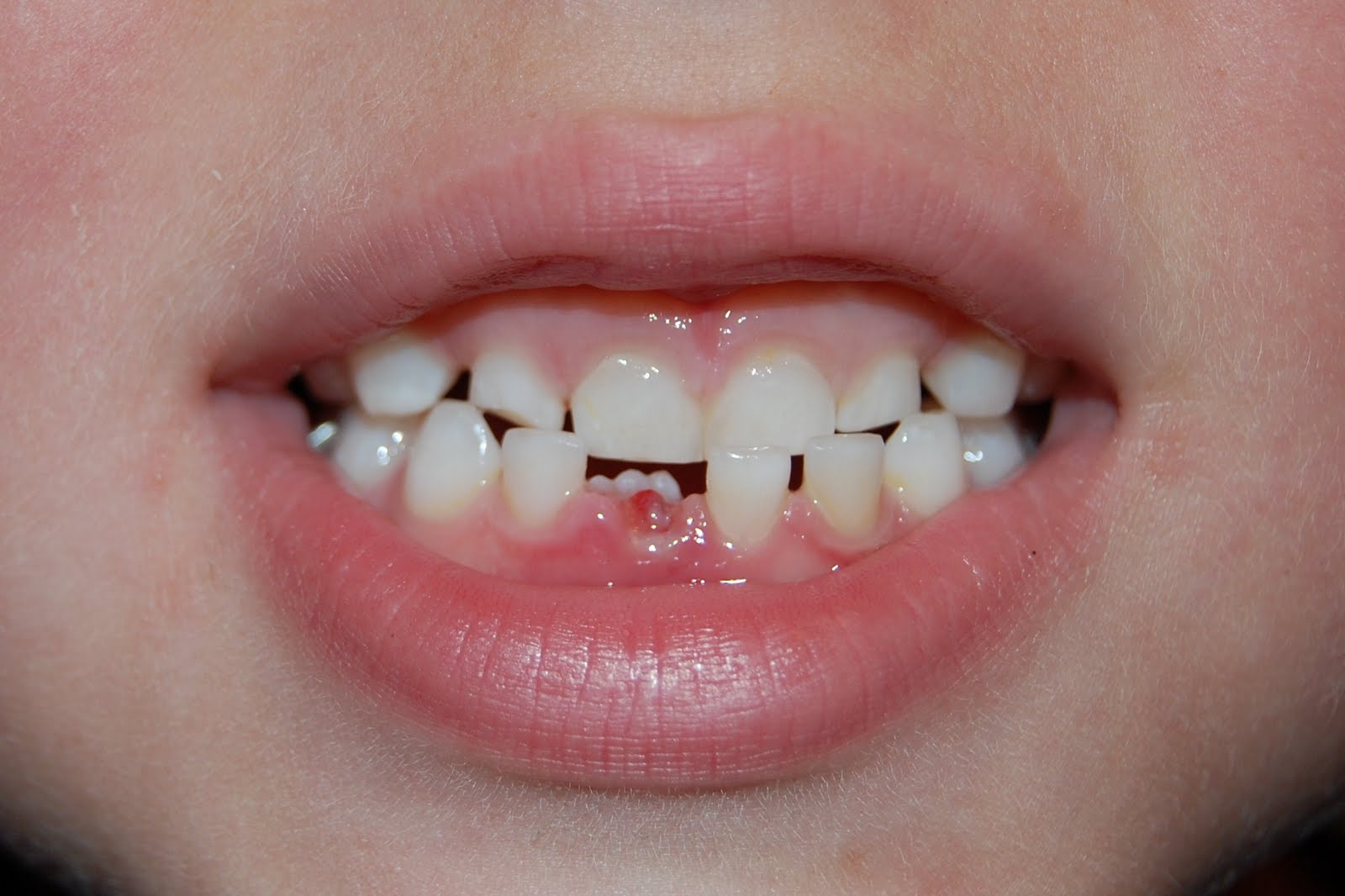 My Tooth Fell Out But The Root Is Still In harcines