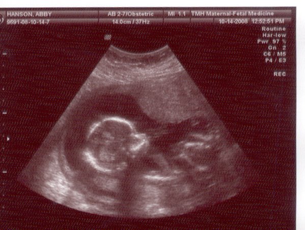 [ultrasoundbaby4.2.bmp.jpg]